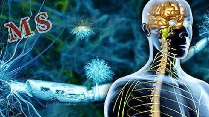 کمبود ویتامین دی: یک عامل خطرناک در افزایش احتمال ابتلا به ام‌اس!